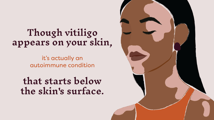 Though vitiligo appears on your skin, it's actually an autoimmune condition that starts below the skin's surface