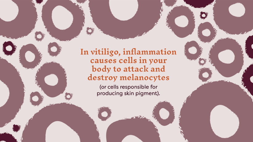 In vitiligo, inflammation causes cells in your body to attack and destroy melanocytes (or cells responsible for producing skin pigment)
