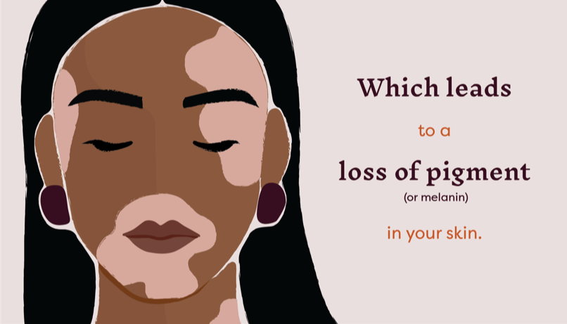 Which leads to a loss of pigment (or melanin) in your skin